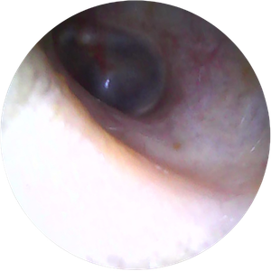 digital photo showing ear wax after ear irrigation carried out by Earresistible in Nottingham