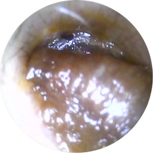 digital photo showing ear wax before ear irrigation carried out by Earresistible in Nottingham
