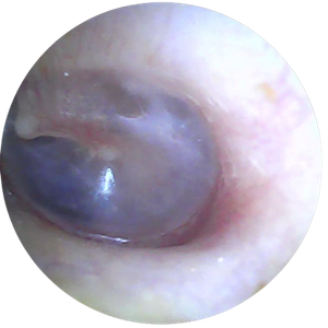 digital photo of inside ear showing ear wax after microsuction ear wax removal carried out by Earresistible in Nottingham