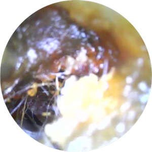 digital photo of inside ear showing ear wax before microsuction ear wax removal carried out by Earresistible in Nottingham